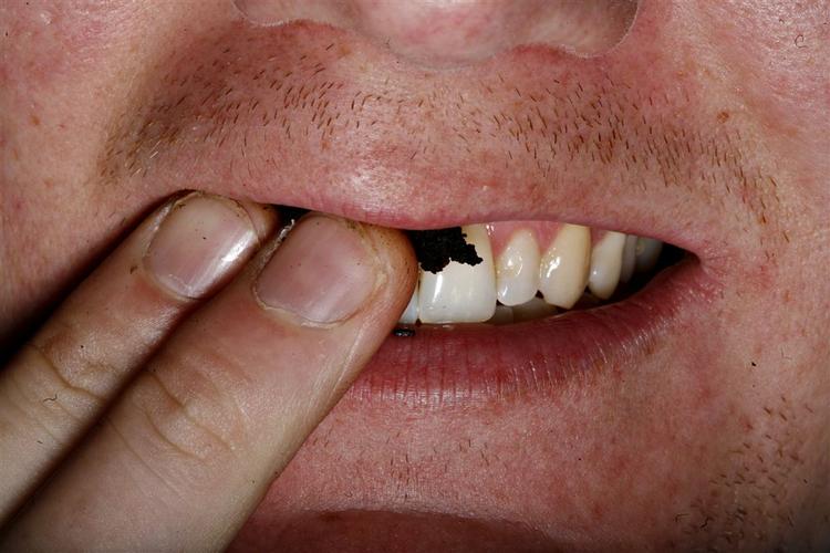 Den største svenske snus-fabrikant har et minus på 150 mio. i år. 