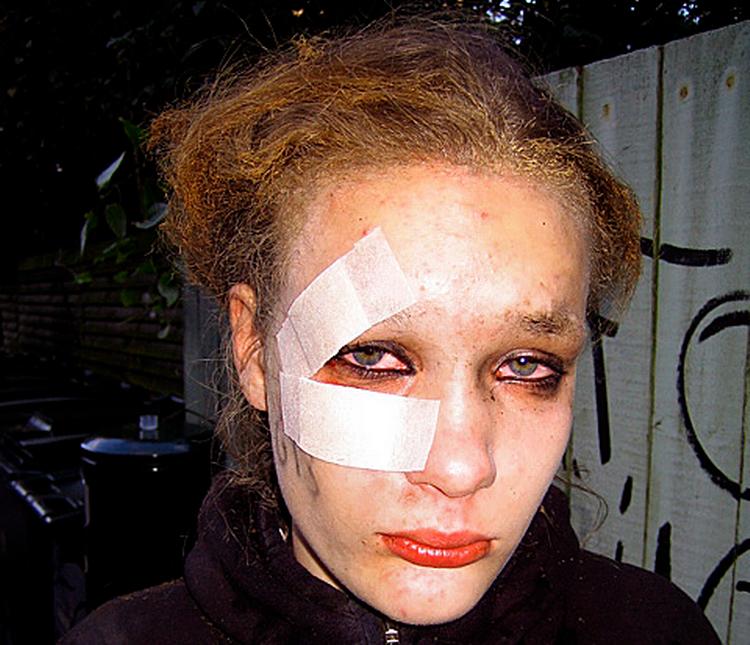 Cecilie Bøsling kort efter episoden. Hun er fotograferet i gården på Borups Alle 150, hvor hun fik førstehjælp. Hår og øjebryn er svitset af, og hun har fået flænger ved højre øje, som hun også har nedsat syn på de næste dage. 