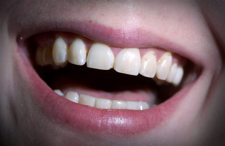 Det store smil er fremme - danskernes tænder har aldrig været bedre. 
