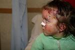 Et uidentificeret barn på hospitalet efter en eksplosion på et våbenlager nær Albaniens hovedstad, Tirana. 