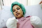 Et år efter at Nour Miyati i 2004 var kommet til Saudi-Arabien for at tjene i huset, endte hun på hospitalet med skader på syn og hørelse, en udslået tand og koldbrand i hænder og fødder. Hun siger, at skaderne var resultat af et års systematisk mishandling.  Foto: Zainal Abd Halim/Reuters 