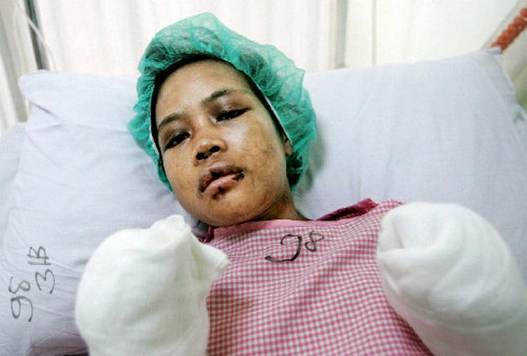 Et år efter at Nour Miyati i 2004 var kommet til Saudi-Arabien for at tjene i huset, endte hun på hospitalet med skader på syn og hørelse, en udslået tand og koldbrand i hænder og fødder. Hun siger, at skaderne var resultat af et års systematisk mishandling.  Foto: Zainal Abd Halim/Reuters 
