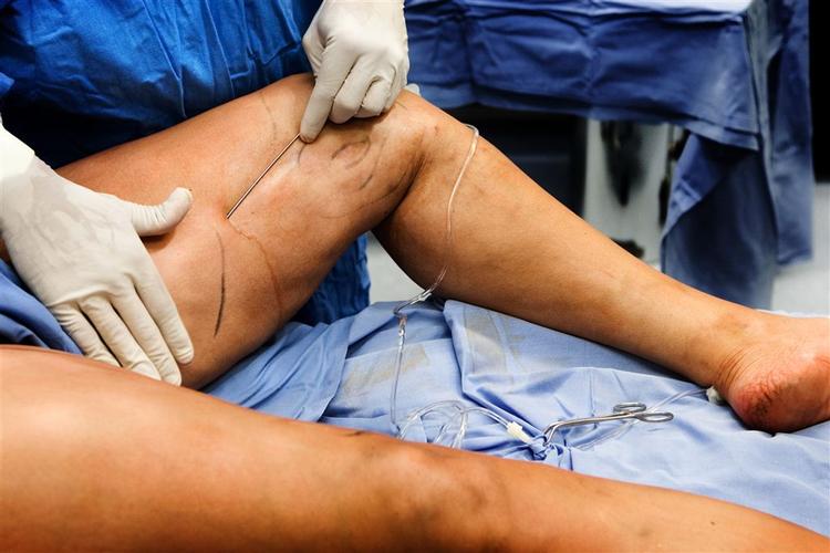 I 2005 blev bare 276 opereret mod fedme. Året efter var det dobbelt så mange, og i år ser det altså ud til at kunne blive 2.000. Billedet er fra en fedtsugning af et inderlår. 
