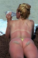 En skoldet krop kræver store mængder vand - ikke after sun eller creme. 