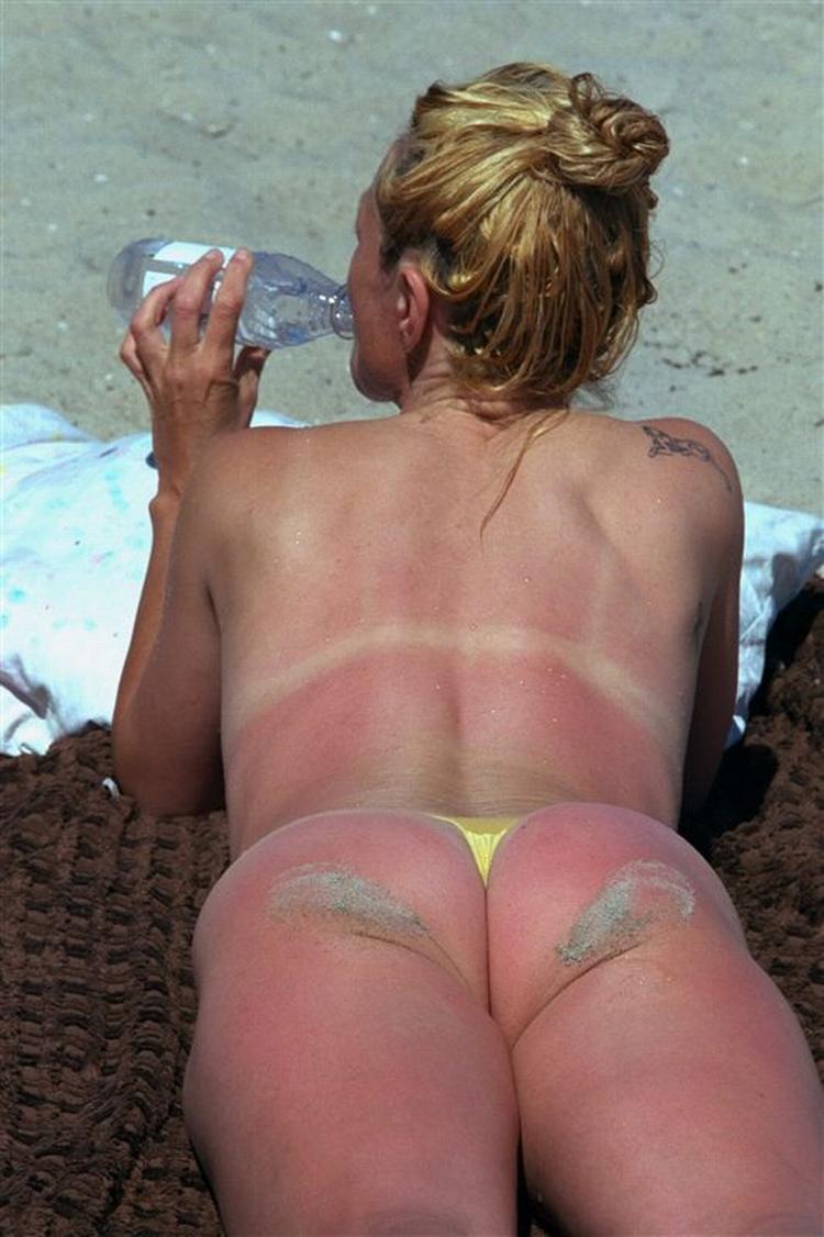 En skoldet krop kræver store mængder vand - ikke after sun eller creme. 