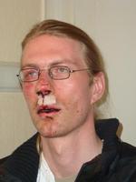 Den 28-årige Peter Hegner Bonfils efter overfaldet. Privatfoto 