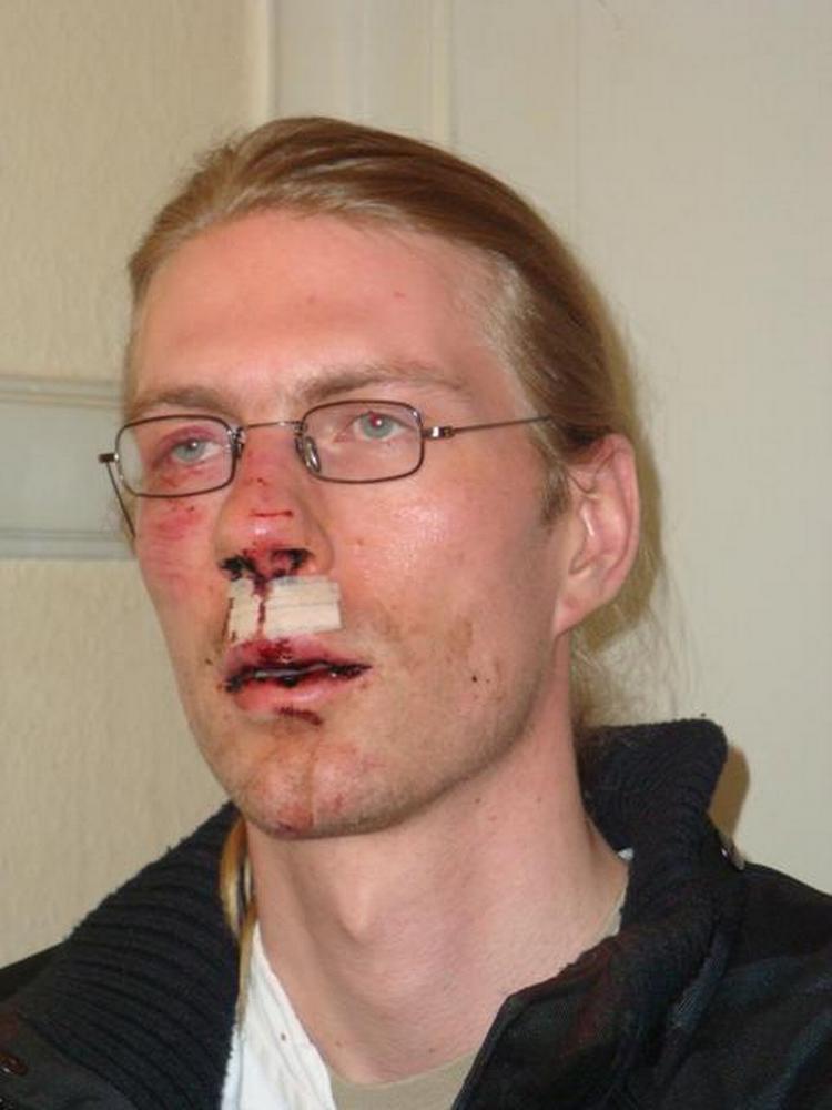 Den 28-årige Peter Hegner Bonfils efter overfaldet. Privatfoto 