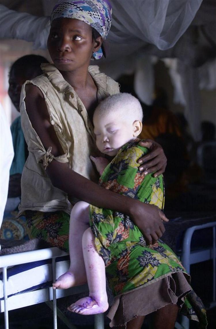 Der har været 27 mord på albinoer i Tanzania siden marts. De menes at bringe held og kropsdelene bliver brugt i trylledrikke. 