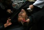 En såret palæstinenser i Gaza hjælpes. Han er en af de 3.300, der er blevet såret som følge af Israels angreb. 