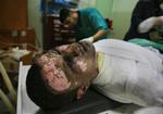 En brandsårpatient fotograferet på Nasser-hospitalet i den sydlige del af Gaza-striben søndag. Lægerne vurderer at han kan være offer for hvid fosfor. 