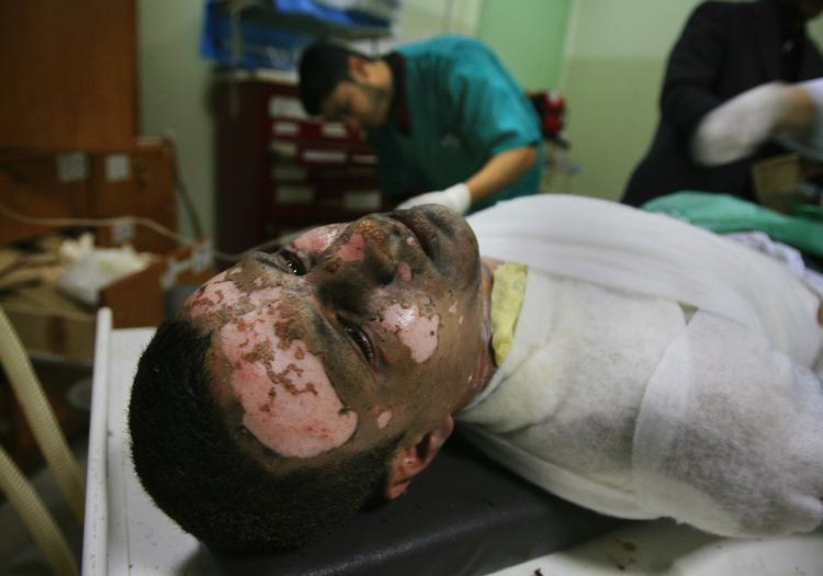 En brandsårpatient fotograferet på Nasser-hospitalet i den sydlige del af Gaza-striben søndag. Lægerne vurderer at han kan være offer for hvid fosfor. 