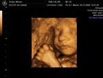 Lidt mindre ukendt. Billederne er resultatet af en 3D-skanning af skribentens endnu ufødte baby og er foretaget på en privat skanningsklinik i København i november 2008. Barnet er sat til at blive født5. februar 2009. På billederne her kan man se babyens ansigt og navlestrengen. Det er normalt og ufarligt, at babyer ligger og vikler sig ind i navlestrengen inde i livmoderen. 