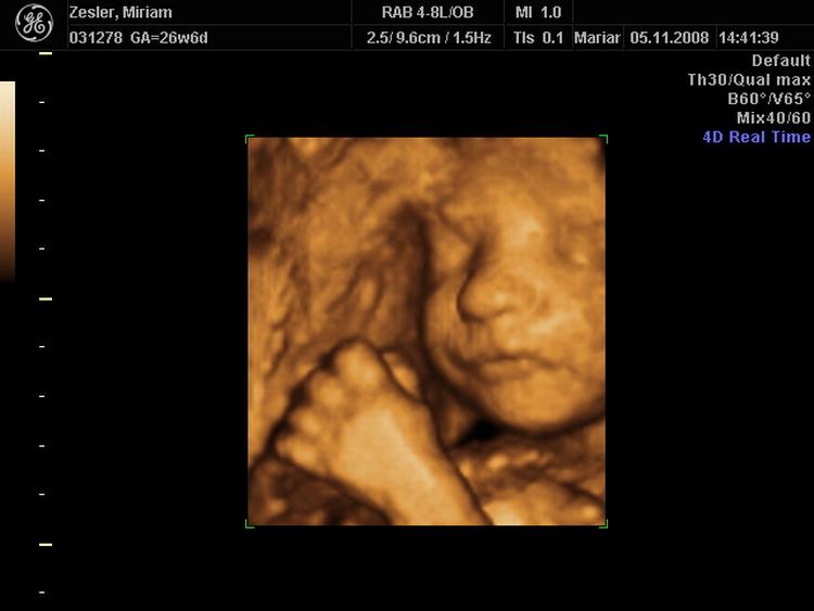Lidt mindre ukendt. Billederne er resultatet af en 3D-skanning af skribentens endnu ufødte baby og er foretaget på en privat skanningsklinik i København i november 2008. Barnet er sat til at blive født5. februar 2009. På billederne her kan man se babyens ansigt og navlestrengen. Det er normalt og ufarligt, at babyer ligger og vikler sig ind i navlestrengen inde i livmoderen. 