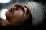 16-årige Ayad Salem blev såret i det ene øje, da han og vennerne kastede med noget, det troede var legetøj. et viste sig at være en  israelsk mortergranat. 