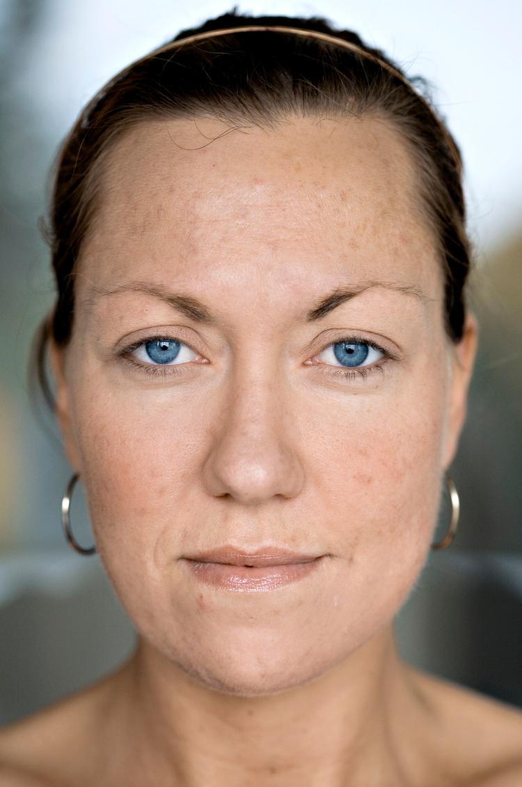 »Jeg kan mærke, at min hud er blevet en smule blødere, men arrene er præcis, som de var, før jeg begyndte at smøre mig med cremen«, siger Pernille Gormsen. 