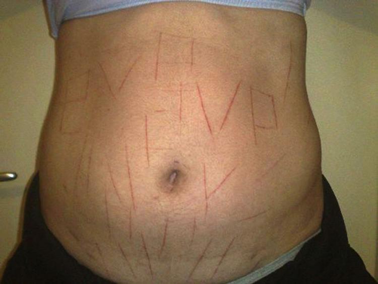Den brasilianske kvinde Paula Oliviera viser sin mave frem. Hun siger, tre skinheads snittede bogstaver ind i huden. 