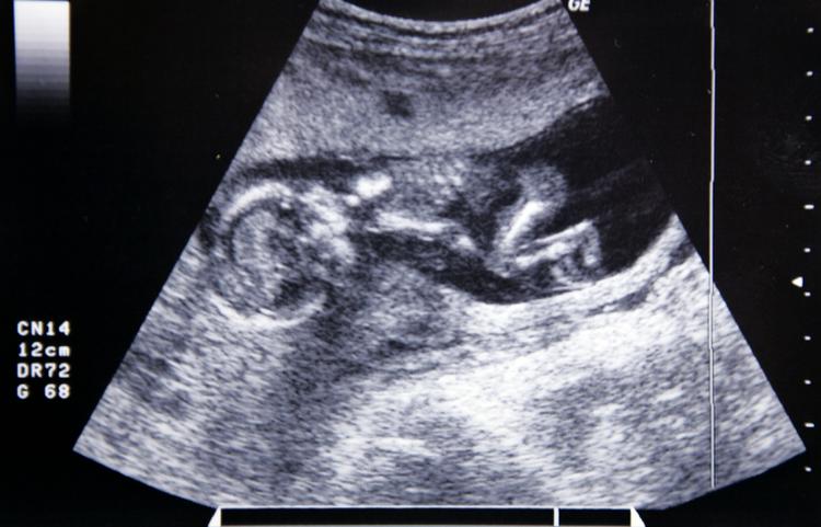 Pige eller dreng? Mellem fem og ti gravide kvinder i Danmark vælger en abort, fordi de venter en pige. (Arkivfoto) 