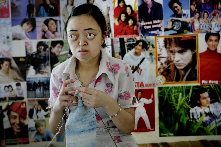 Loung Nguyen Thi Van er et af 'Agent Orange'-ofrene. Hun er hjerneskadet og ramt af misdannelser, forårsaget af den amerikanske giftsprøjtning. Arkivfoto. 
