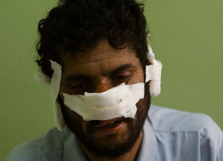 Taleban huggede ørerne og næsen af 40-årige Mohammad Lal, fordi han var på vej til valgsted. 
