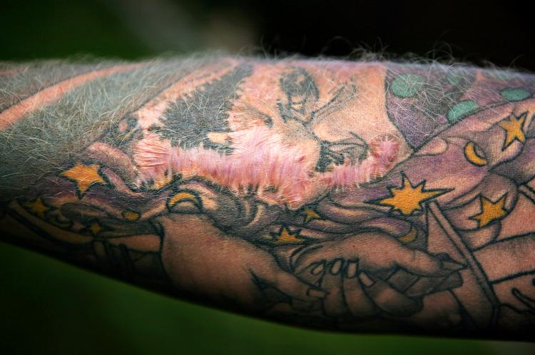 Den flotte tatovering på Tom Hjorths underarm er i dag erstattet af skæmmende ar midt i et forplumret farveorgie.. 