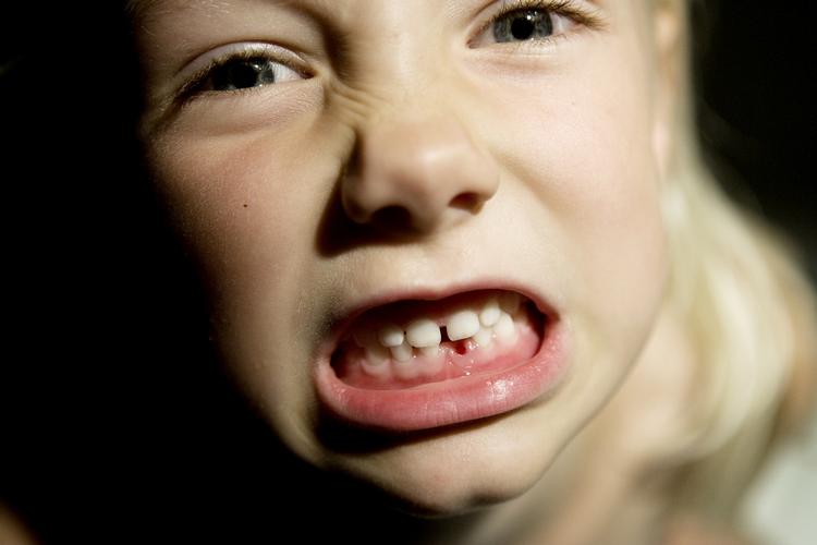 Hvis mor eller far smager på barnets ske eller gør sutten 'ren' ved at putte den i munden, kan de smitte barnet med karies bakterier, der senere giver barnet huller i tænderne. Her er det dog bare en rokketand, der har skabt et hul i tandrækken. 