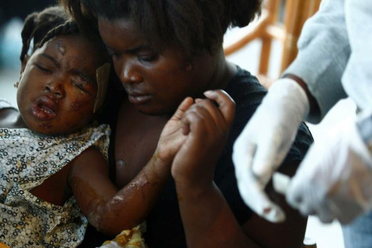 Smerte. Den lille pige får behandling hos nødhjælpsorganisationen 'Håb for Haiti'. Titusinder af hendes landmænd har formentlig mistet livet. 