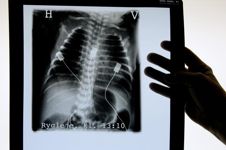 Passiv rygning generer også børn. Hvert år indlæggges tusindvis af børn på danske hopsitaler. Røntenbilledet af lungerne af en nyfødt baby undersøges på Hvidovre Hospital. (Arkivfoto) 