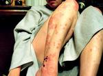 Hudproblemer. Der er mange myter om psoriasis - blandt andet at det smitter. (arkivfoto: mysiana/Flickr) 