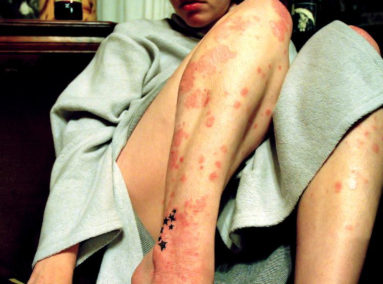 Hudproblemer. Der er mange myter om psoriasis - blandt andet at det smitter. (arkivfoto: mysiana/Flickr) 