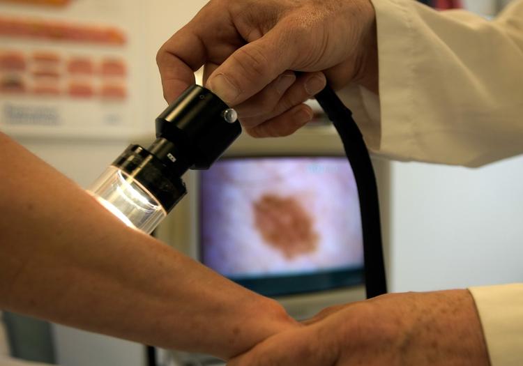 Hudkræft. Forstadier til hudsygdommen pladecellekræft kan nu behandles med en ny plantemedicin. 