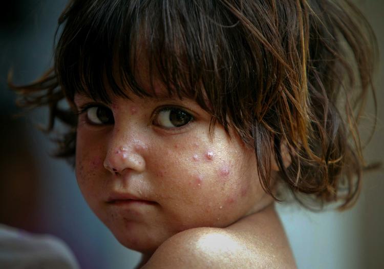 myggebidt. Denne lille pige er blevet angrebet af myg. Hun bor i en af hærens midlertidige lejre i Nowshera i Pakistan. 