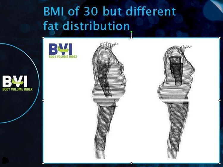 Fedtfordeling. Begge disse personer har et BMI på 30 - men med forskellig fedtfordeling.Personen til venstre har fedtet på maven, og det er farligst. Netop mavefedtet tages der højde for i den nye BVI-måleteknik. 