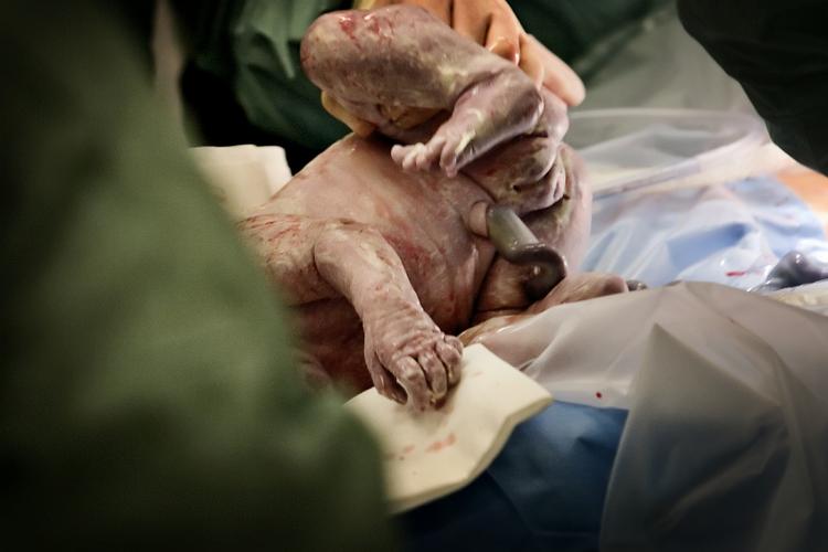 Et nyt lille barn kommer til verden på Hvidovre Hospital. På billedet er det sket ved kejsersnit. Arkivfoto. 