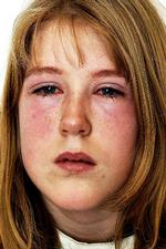 Reaktion. Dagen efter en øjenvippefarvning måtte Sophie Havmand, dengang 12 år, en tur på hospitalet. Her er hævelsen på retur. 