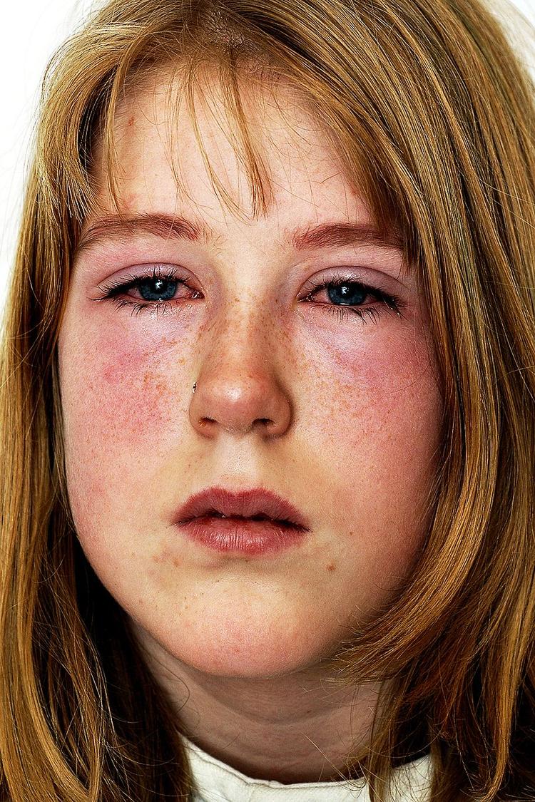 Reaktion. Dagen efter en øjenvippefarvning måtte Sophie Havmand, dengang 12 år, en tur på hospitalet. Her er hævelsen på retur. 