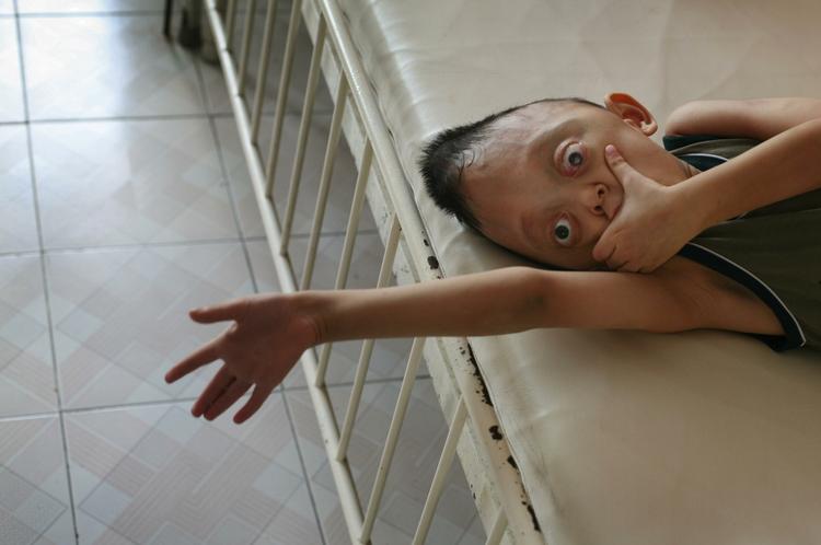 GIFTSKADER. 'Agent Orange' blev benyttet i store mængder af USA under Vietnamkrigen, hvor mange børn i dag lever med misdannelser, som krigsgiftene mistænkes for at være skyld i. 