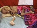 Sult. Et barn venter på hjælp på Banadirhospitalet i Mogadishu i Somalia. 