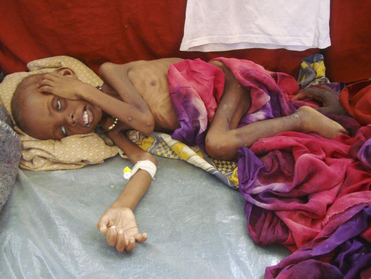 Sult. Et barn venter på hjælp på Banadirhospitalet i Mogadishu i Somalia. 