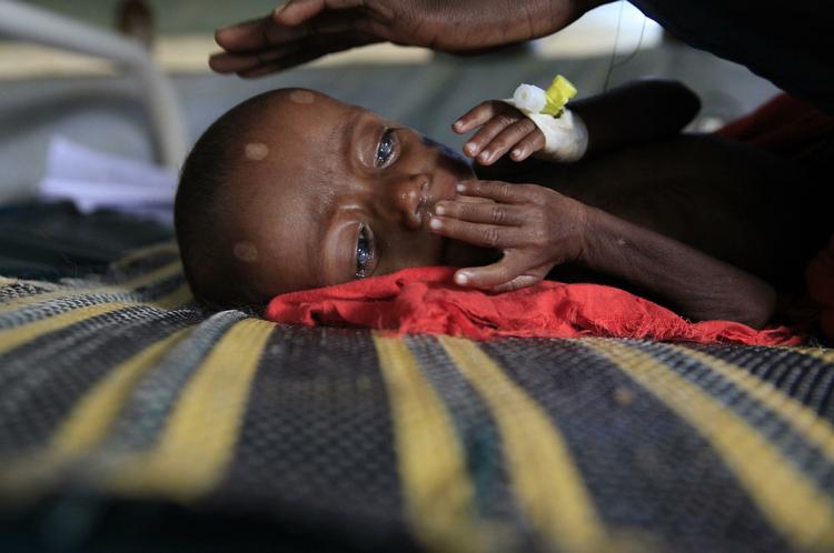 Sult. Habibo Bashir på et år er en af tusinder småbørn, der lider af under- eller fejlernæring på Afrikas Horn. 