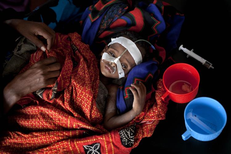 underernæret. Hussein Liban på halvandet år er svært underernæret. Han befinder sig nu på et hospital i en flytningelejr i Dadaab i Kenye nær grænsen til Somalia. Den lille dreng her får proteinvæske gennem næsen hjulpet af sin mor, 30-årige Ibrahini Kapopow. 