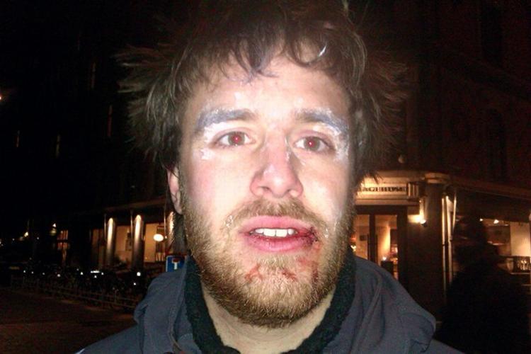 Foto: Maja Lærke Maach. Mads Holscher fik flækket sin læbe, da en betjent slog ham i hovedet med sin politistav. det hvide omkring øjnene er salve, som hjælper mod den peberspray, han også blev ramt med. 