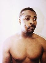 Overfald. Dette foto af Rodney King blev taget tre dage efter, hans krop blev overdænget af slag fra fire betjentes knipler i Los Angeles i marts 1991. 