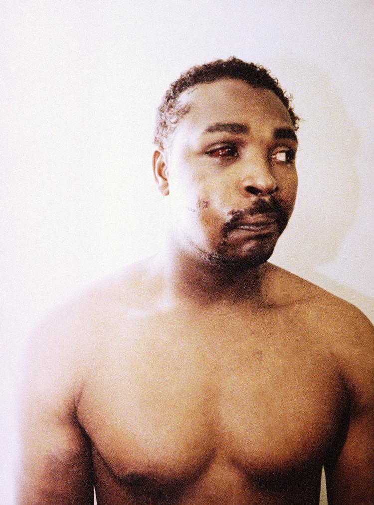 Overfald. Dette foto af Rodney King blev taget tre dage efter, hans krop blev overdænget af slag fra fire betjentes knipler i Los Angeles i marts 1991. 