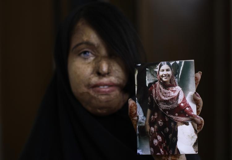 VANSIRING. Tidligere har syreangreb næsten udelukkende fundet sted i mellemøstlige og asiatiske lande. Denne pakistanske kvinde blev overhældt med syre i 2003, efter hun nægtede at gifte sig med sin undervisers ven. 