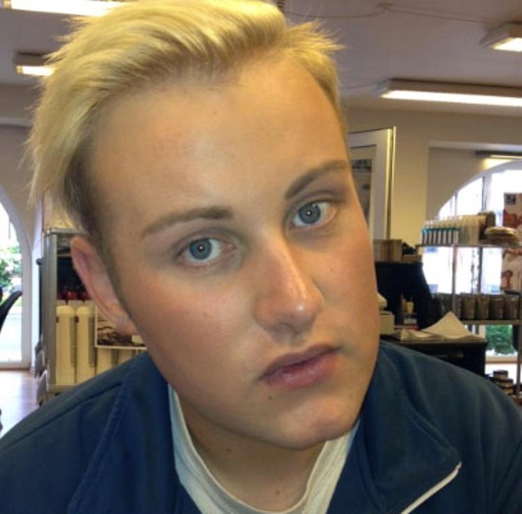 Før og efter. Daniel Højgaard  brugte for halvanden måned siden 2.400 kroner på at få sprøjtet botox ind i  panden. Rynkerne i panden gik ud over selvværdet, følte han. 