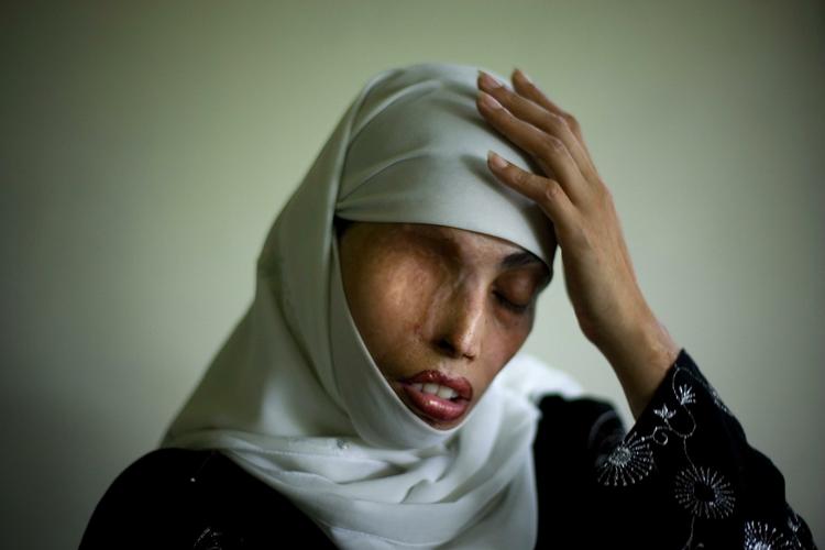 ÆRESFORBRYDELSER. Hvert år angribes et stort antal pakistanske kvinder med syre. Irum Saeed fik smidt det i ansigtet på åben gade af en mand, hun havde afvist at ægte. Nu sidder et pakistansk par fængslet for at slå deres teenagedatter ihjel, fordi hun kom til at kigge på en dreng. 