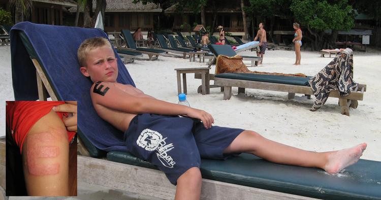 RISIKO. Først var Magnus' hennatatovering flot på stranden i Thailand, men så fik han en voldsom allergisk reaktion. 