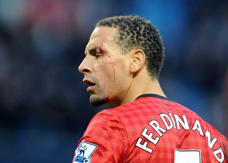 såret. En mønt fra tilskuerpladserne ramte Rio Ferdinand over det ene øje. 