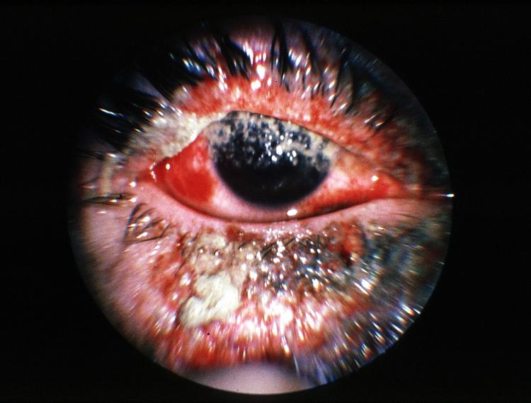 Syn. Nytårsaften er desværre højtid for alvorlige øjenskader. Alle bør bruge sikkerhedsbriller, siger øjenlæge, der i årevis har lavet statistik om øjenskader nytårsaften. 