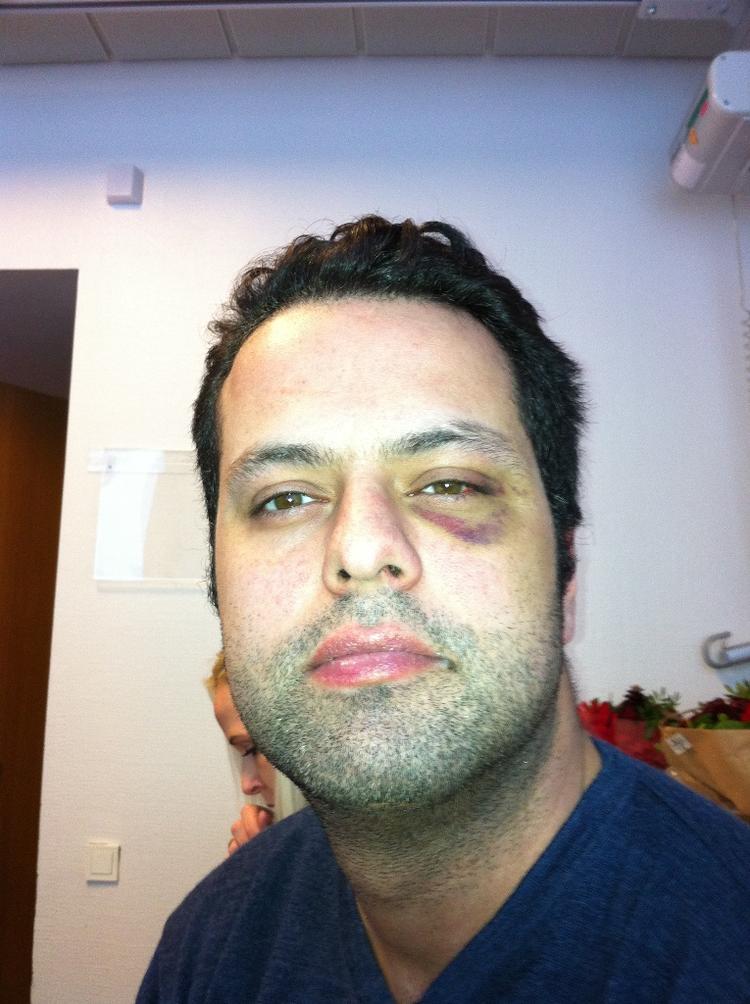 Stop. Ifølge Amin Skov selv blev han overfaldet 21. december på Restaurant Vejlegården, og sådan her så han ud ved nytårstid på hospitalet. Stadig med tydelige spor efter slag i hovedet. Skov har svært ved at huske, hvad der præcist skete den skæbnesvangre aften, men han er træt af de mange konspirationsteorier, der vedholdende svæver om hans person. For nej, han har ikke selv noget at gøre med den brand, understreger han i et interview med politiken.dk. 